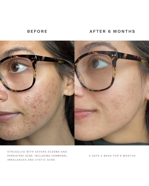 lifestyle image of Red Light Face Mask